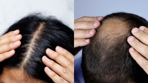 Scientists Reveal Breakthrough Hair Loss ‘Cure’ That Could Work in Just 20 Days