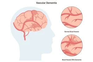 Dementia expert says nearly half of cases could be prevented with three simple changes