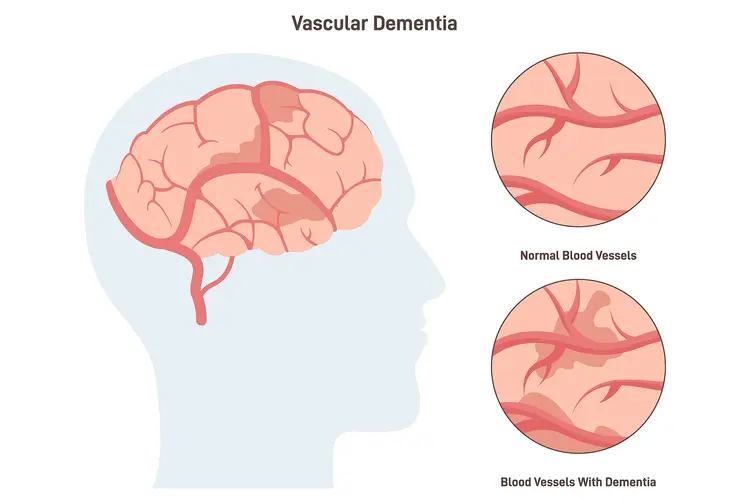 Dementia expert says nearly half of cases could be prevented with three simple changes